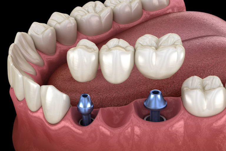 Model of a single dental implant with a crown