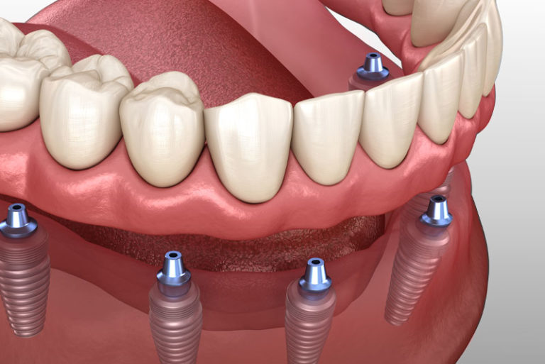Model of a denture that snaps onto dental implants