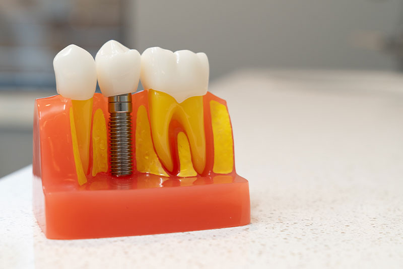close up of dental implant model.