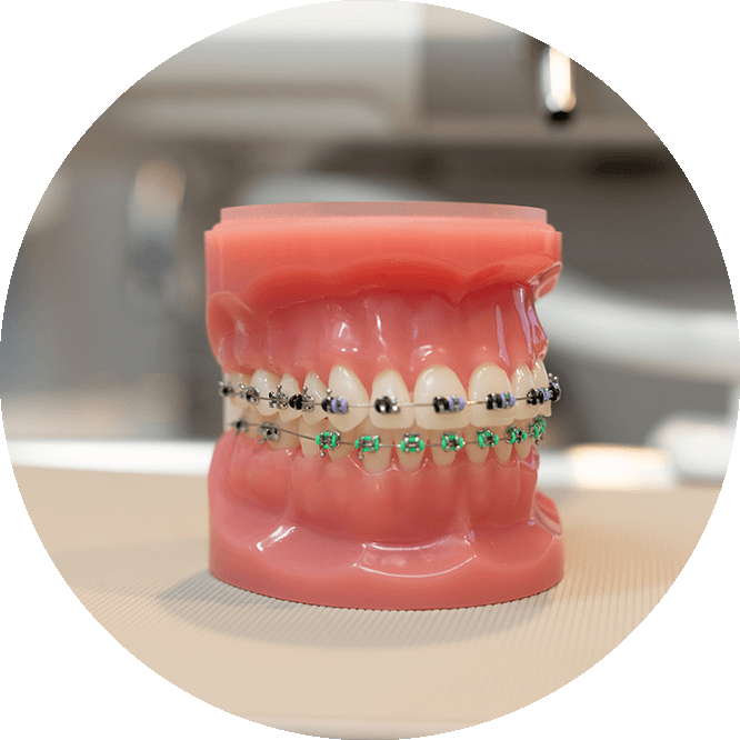close p of braces model within the dental cneter